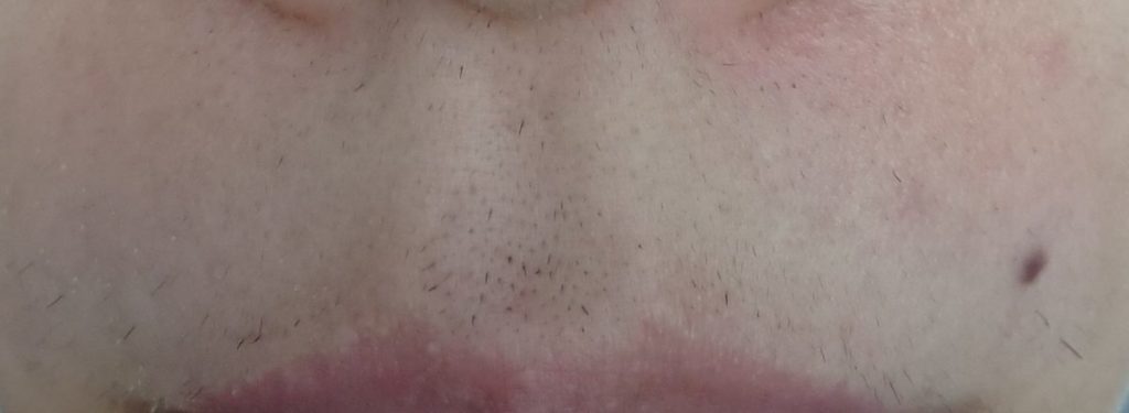 鼻下１２回目脱毛開始直前の剃毛１週間後